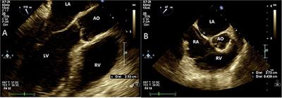 Increased Mobility of the Atrial Septum in Aortic Root Dilation: An Observational Study on Transesophageal Echocardiography